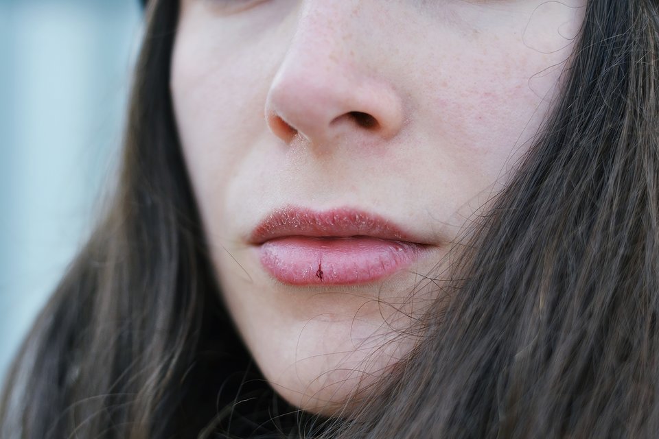 rsz_how-to-combat-chapped-lips